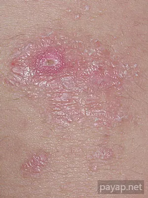 帯状疱疹(ヘルペス)