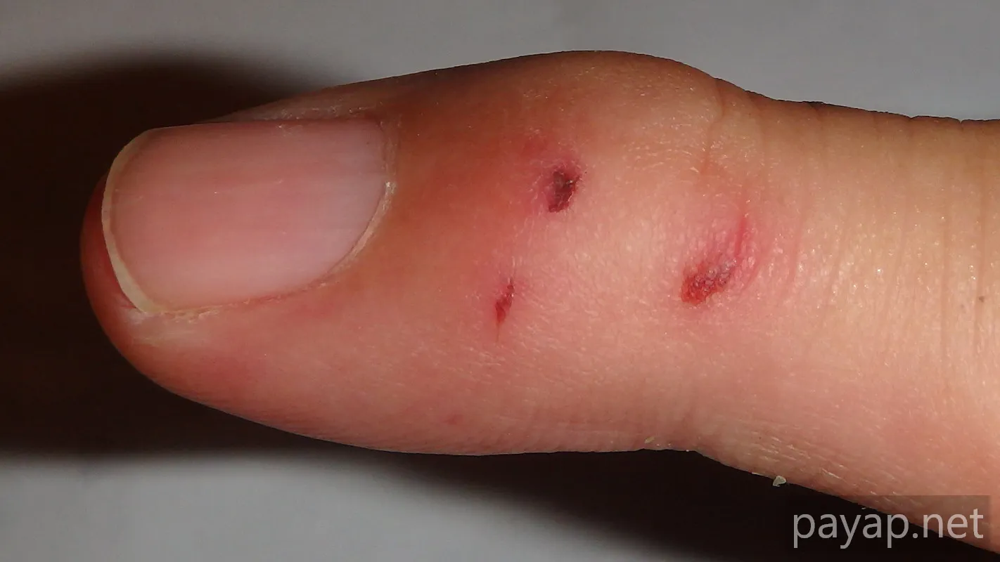 猫に噛まれた小指